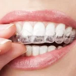 Crucial Steps To Follow After Getting Invisalign Braces